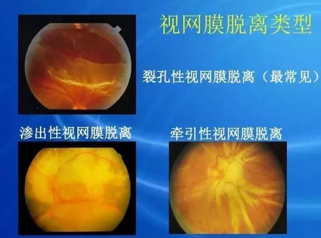 眼底病|眼底病检查与病例分析