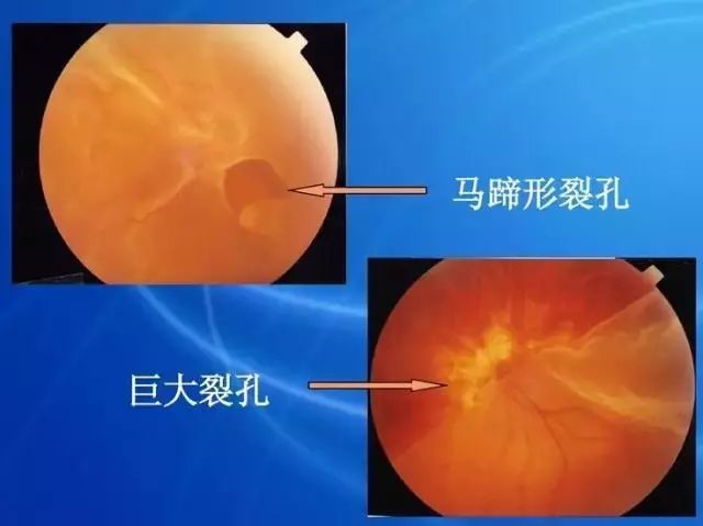 眼底病|眼底病检查与病例分析