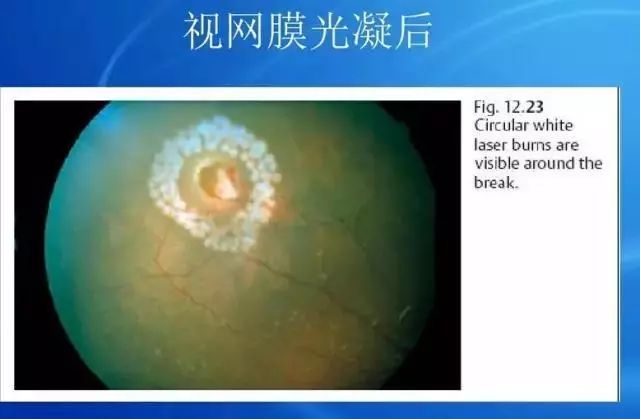 眼底病|眼底病检查与病例分析