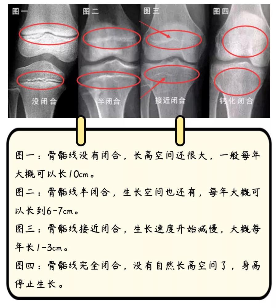 骨骺線是指長骨幹骺端與骨骺之間的一層軟骨,用於長高.