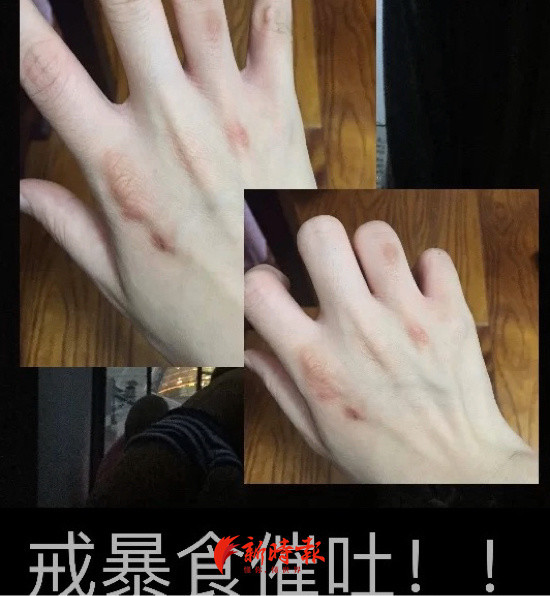 为变瘦她们催吐成瘾医生操作不慎或导致消化道出血