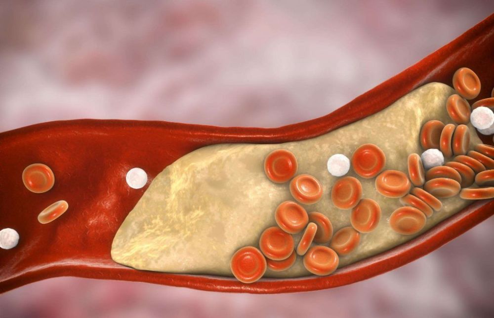 高血脂|高血脂严重危害人体健康，科学预防，这4个误区要了解清楚