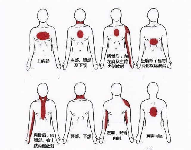 59岁男子多次心梗前兆未重视5点心脏停跳科普心梗前兆