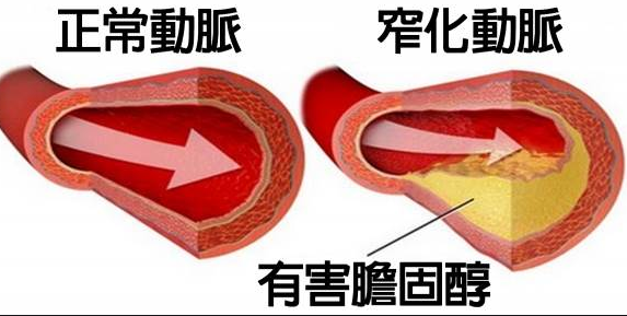 高脂血症|人到中年，4大“升脂大户”最好少吃，预防血管堵塞