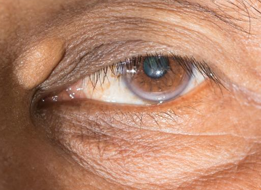 高脂血症|人到中年，4大“升脂大户”最好少吃，预防血管堵塞