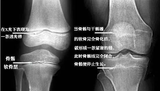 在骨骺与干骺端之间有一块软骨,会随着年龄的不断增长而逐渐变短,在
