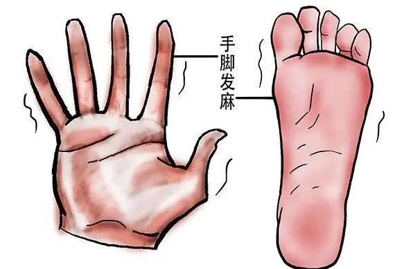 手脚发麻|经常手脚发麻，一定要警惕这几种高发疾病！