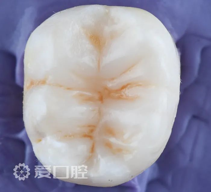 下颌第一磨牙一类洞树脂分层充填欣赏_腾讯新闻