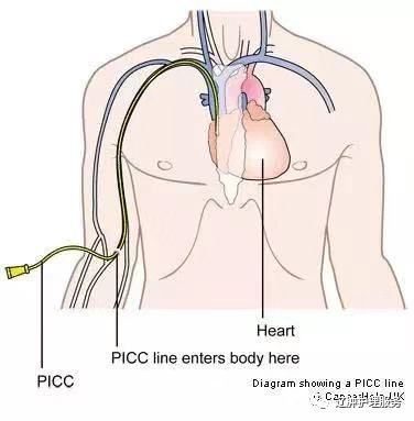 picc|PICC拔管困难不要怕，预防与处理有方法