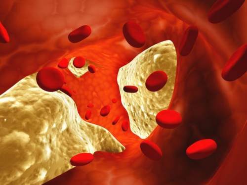 低密度脂蛋白|男子3个月不到，低密度脂蛋白从6.8降到2.7，方法值得借鉴