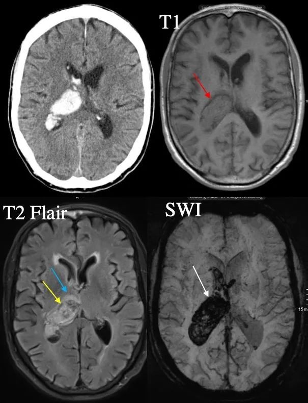 脑出血|理解是最好的记忆——细说脑出血核磁信号演变