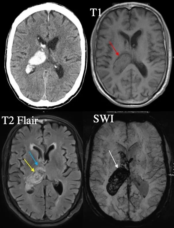 脑出血磁共振图片图片