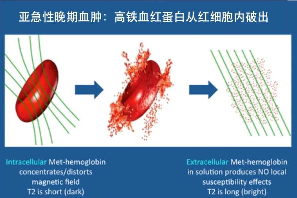 脑出血|理解是最好的记忆——细说脑出血核磁信号演变