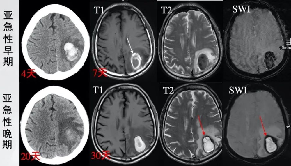 脑出血|理解是最好的记忆——细说脑出血核磁信号演变