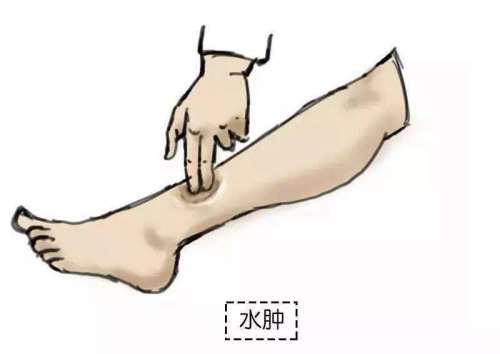 肾病|腿是肾的“侦查员”，腿上亮起3个“火把”，8成是肾要“报废”！