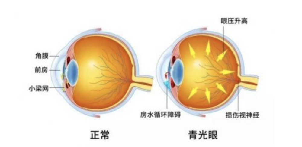 青光眼|男子一口气喝了600毫升水，竟然差点失明，喝水也要有度。