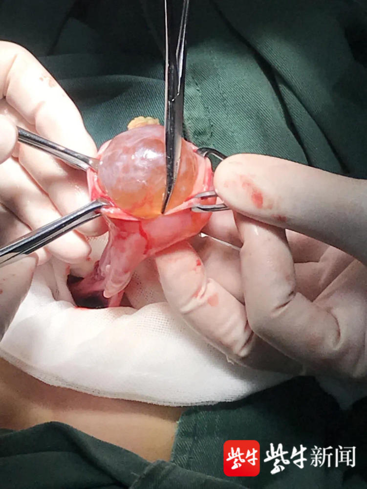 一个小时成功剥离八岁女孩畸胎瘤医院两科联手保住女童卵巢和未来