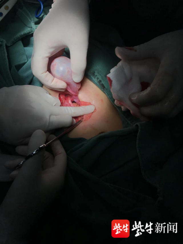 卵巢畸胎瘤手术图片