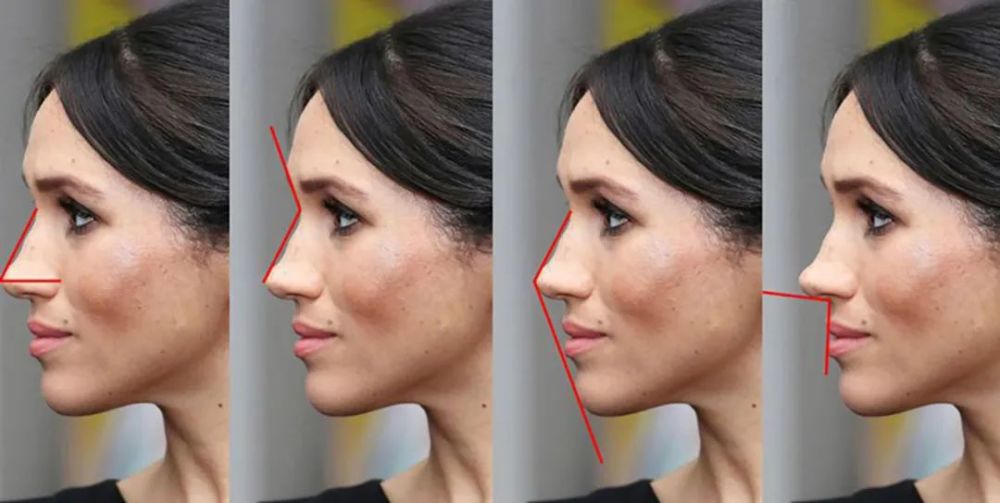 40岁梅根改变原有基因整容导致鼻子变弯侧影呈波浪式好突兀