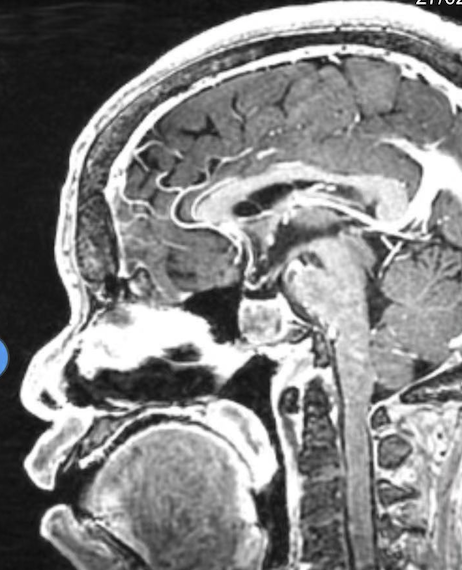 长得越来越丑原来是脑垂体瘤在作怪