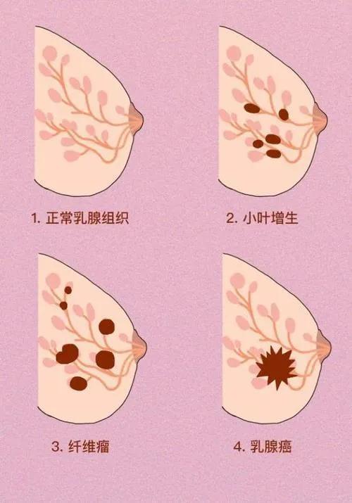 乳腺纤维瘤的位置图片图片