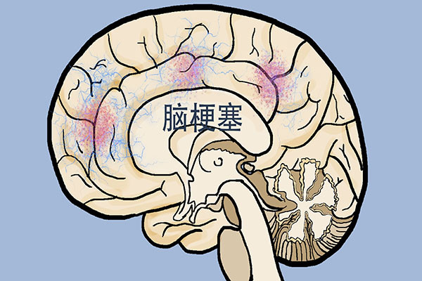 脑中风|中风不是说得就得的，59岁阿姨，及时发现身体异常，救了自己一命