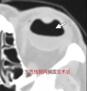 眼球|诊断眼球外伤时，影像医生要留心的6点！