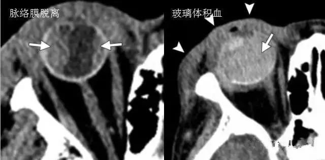 眼球|诊断眼球外伤时，影像医生要留心的6点！