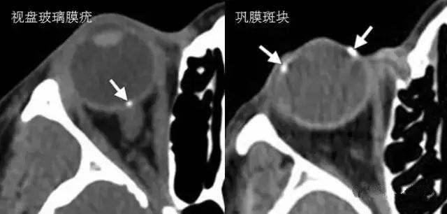 眼球|诊断眼球外伤时，影像医生要留心的6点！