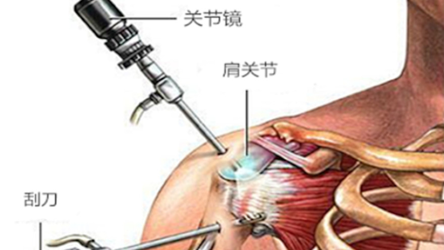 肩峰下撞击综合征|运动治疗无效，怎么办？来自肩峰下撞击综合征患者的疑问