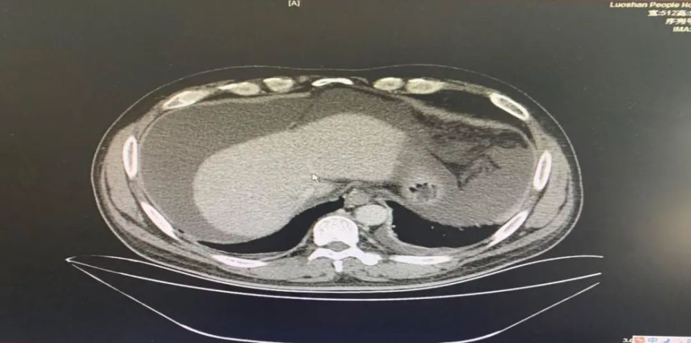 肝纤维化|“肝”于发现，打好护肝保卫战