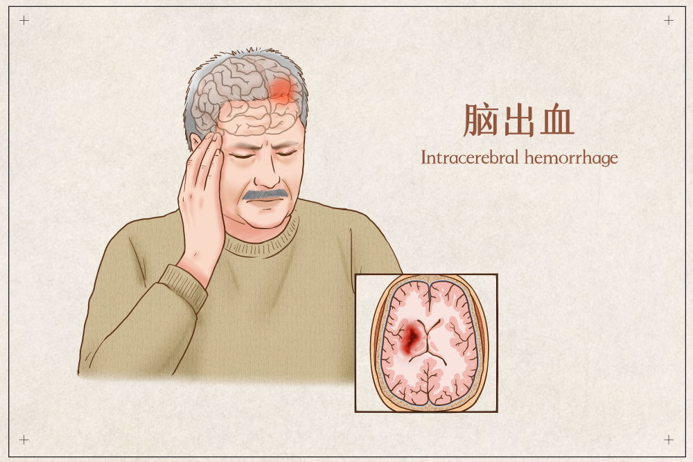 解析:脑溢血后遗症的三大方面_腾讯新闻