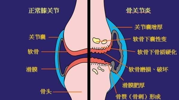 骨关节炎|出现关节疼痛需留心，不要错把类风湿性关节当成骨关节炎！