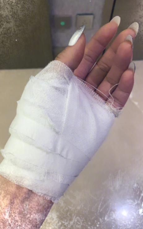 容祖儿晒手部割伤近照!自曝血液从伤口喷出,伤口疤痕堪比毛毛虫