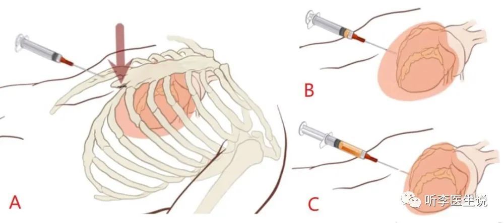 主任跟另一个医生说. 心包穿刺!