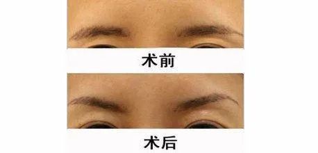 眉弓骨假体 是美丽还是危险 腾讯新闻