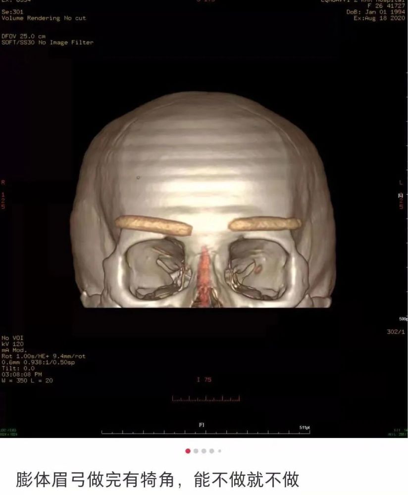 眉弓骨假体 是美丽还是危险 腾讯新闻