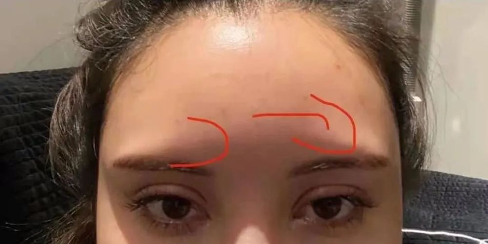 眉弓骨假体 是美丽还是危险 腾讯新闻