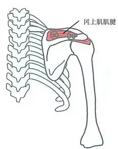 岡上肌肌腱壓痛點此壓痛點在肱骨大結節的岡上肌止點處,按壓時疼痛可