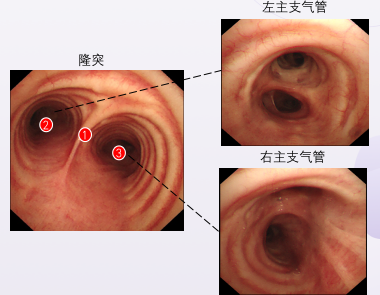 支气管镜进镜总迷路一文教你镜下分辨各级支气管