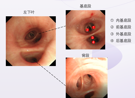 支氣管鏡進鏡總迷路?一文教你鏡下分辨各級支氣管!_騰訊新聞