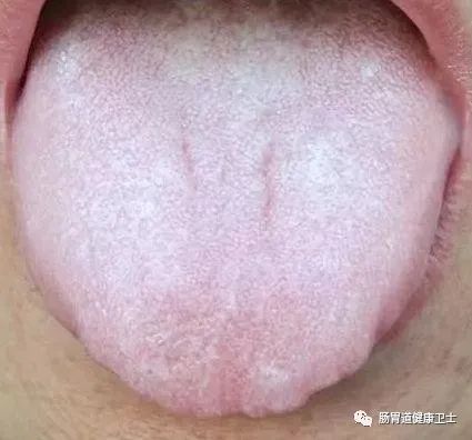 舌頭是健康顯示器中醫教你如何從舌象上看胃病