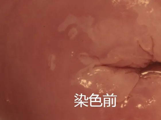 宫颈癌,提前"刷一刷"就能发现这种悄无声息的癌症……_腾讯新闻