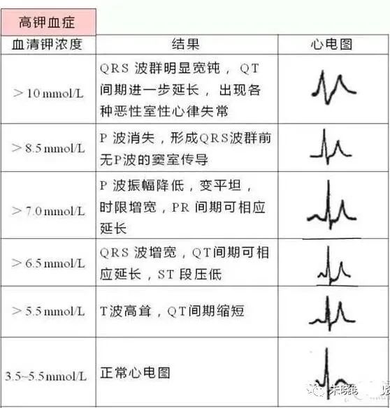 心电图显示t波高尖,可能提示哪些疾病?