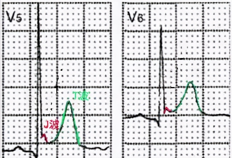 心电图显示t波高尖,可能提示哪些疾病?