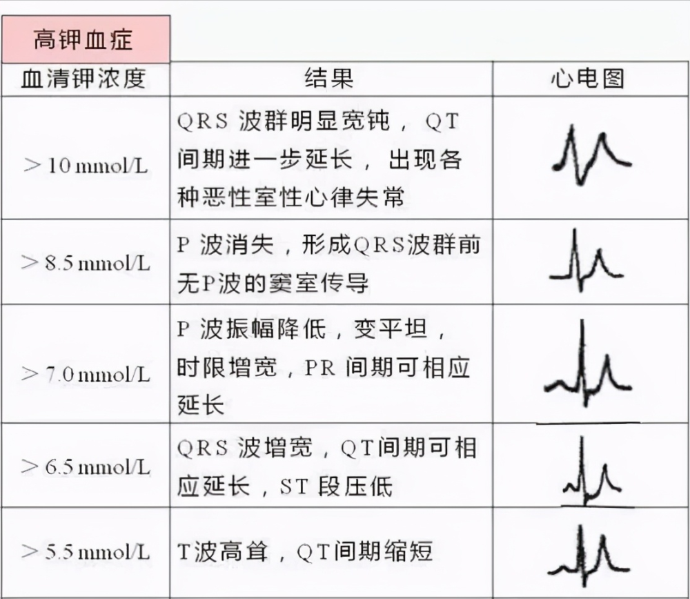 03早期复极综合征心电图特征(1)t波高耸主要见于v2-v4,t波两肢不对称