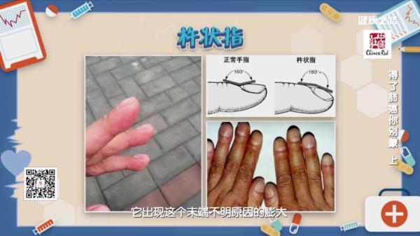 痰中带血胸痛杵状指需注意小心肺癌找上你