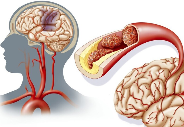 为什么中国脑梗发病率世界第一,远高于美国?医生:3大原因所致|脑梗塞|