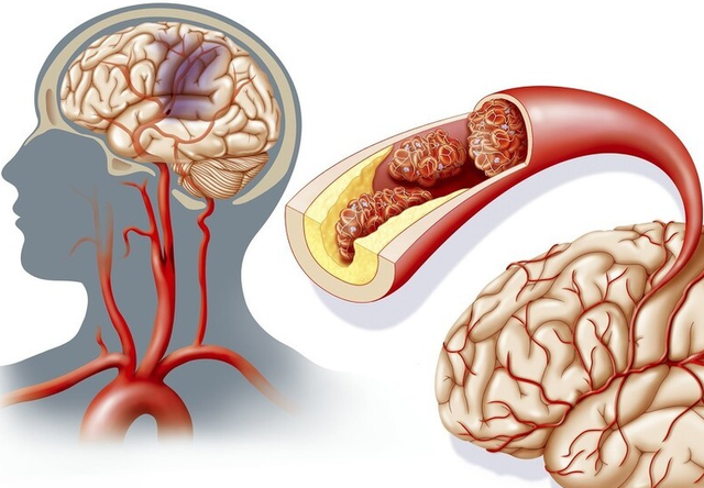 为什么中国脑梗发病率世界第一远高于美国医生3大原因所致