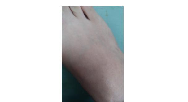 脚背筋膜炎痛点在哪里 腾讯新闻